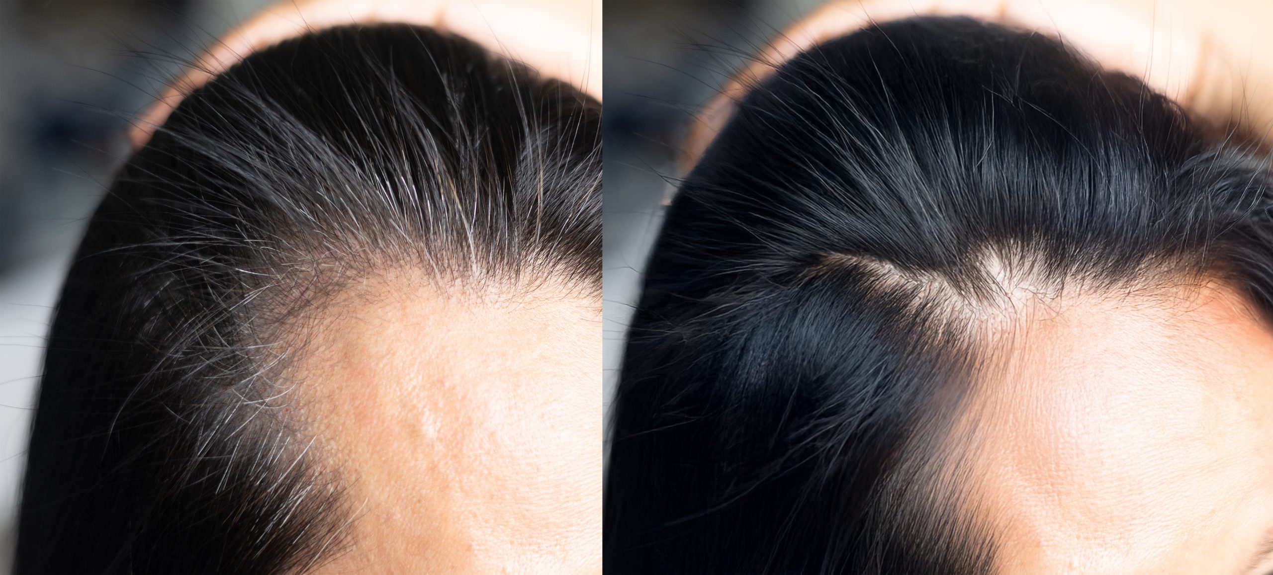 Dökülme karşıtı şampuan